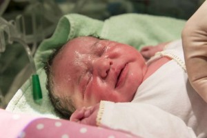 新生儿长红胎记的原因胎记有哪些类型